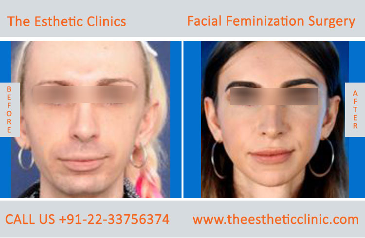 Facial Feminization Surgery before after photos in mumbai india (2)